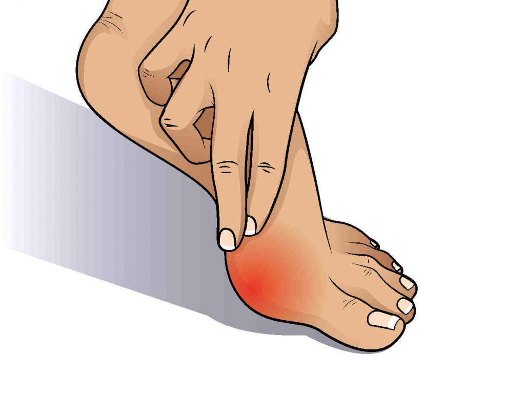 Bunion Therapy And Treatment - Foot And Ankle Podiatrists