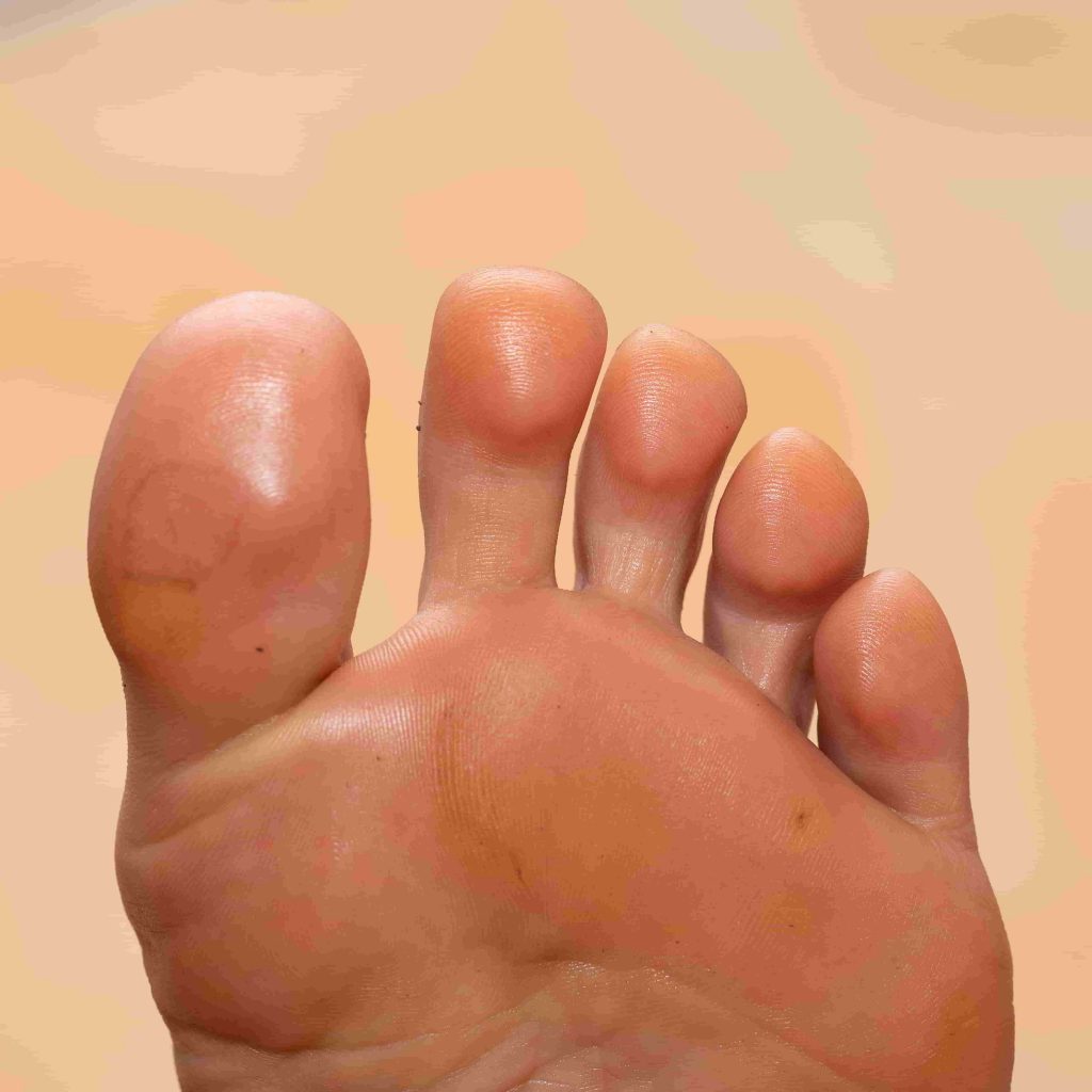Corns & Calluses Foot and Ankle Podiatrists