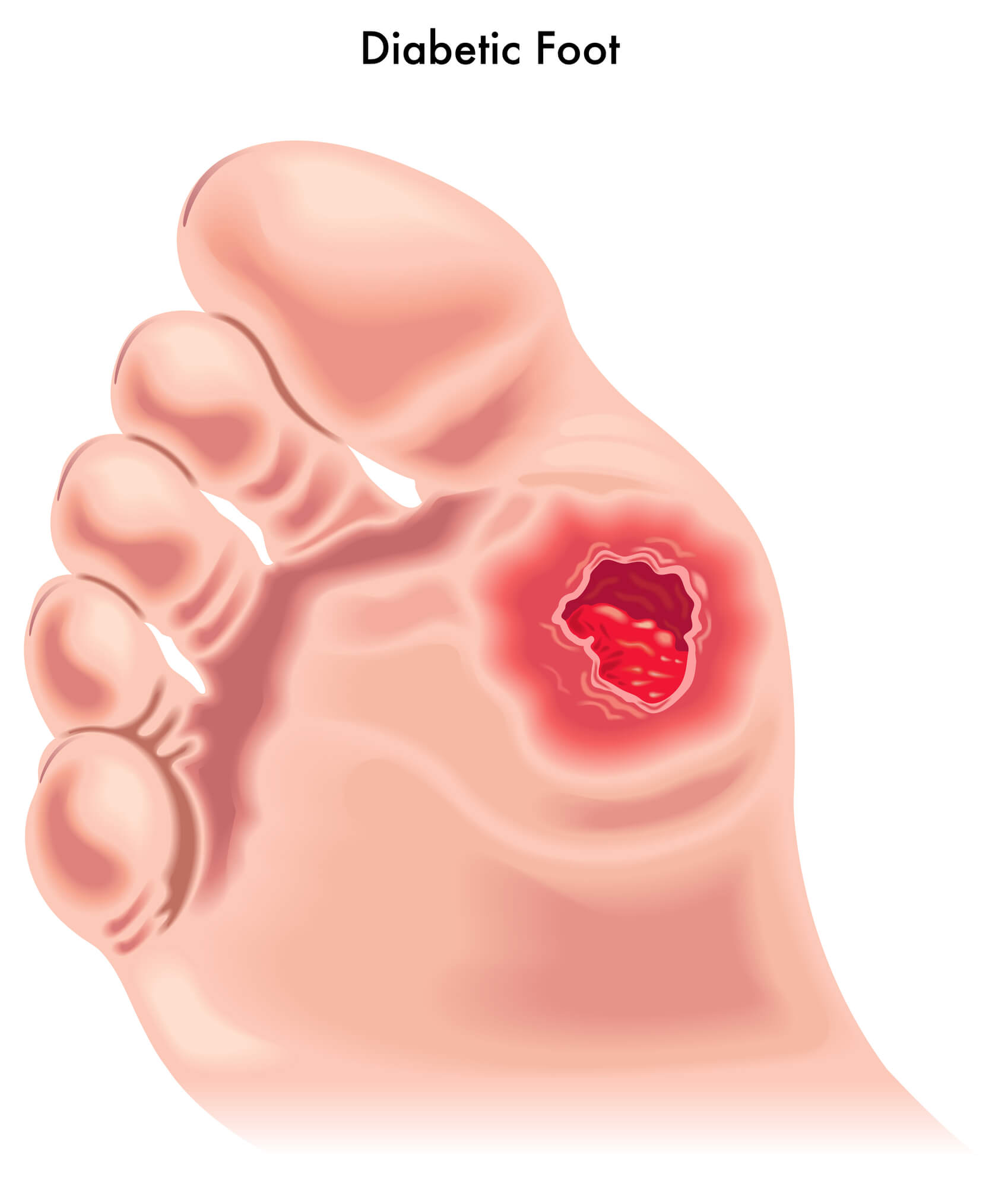 How to Prevent and Treat Diabetic Foot Ulcers - Glencoe Regional Health