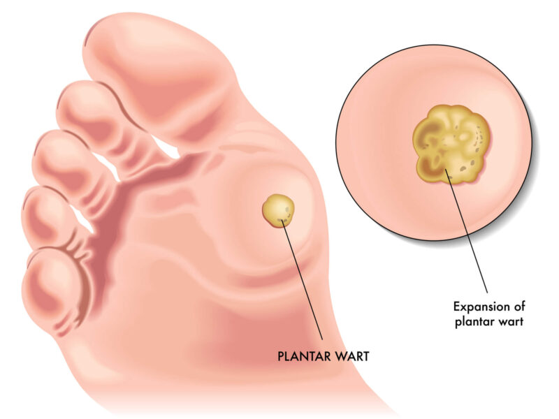 planters wart removal surgery