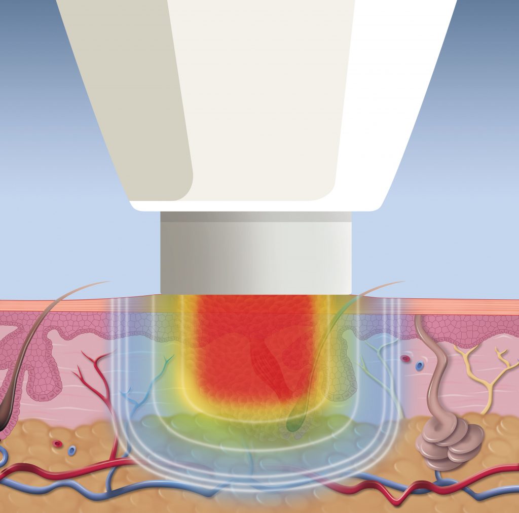 Swift Microwave Therapy