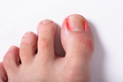 fungus on toenail