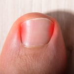 ingrown toenail