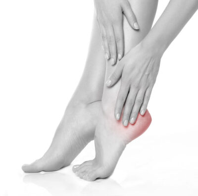 plantar fasciitis