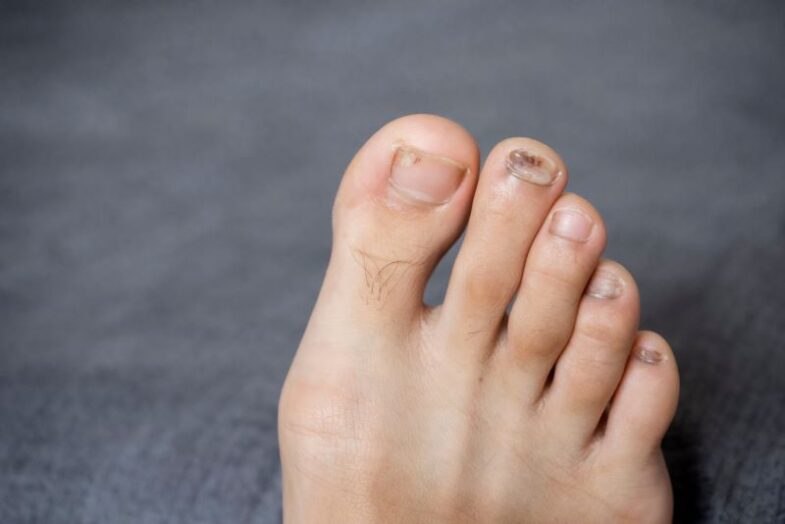 How do you Prevent Athlete's Foot and Nail Fungus? | Sol Foot & Ankle  Centers