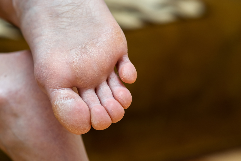 Plantar callus removal: how to get rid of calluses on feet permanently?